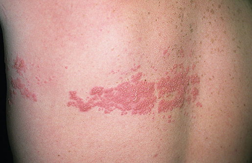 التغذية في مرض الحزام الناري: دليل علمي شامل